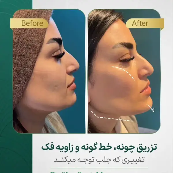 نمونه کار بوتاکس و فیلر