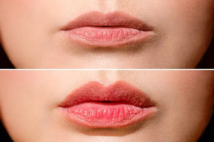 result-before-after-lip-shaping-woman-makes-lip-shape-correction-cosmetology-clinic-lip_168410-2266-ezgif.com-jpg-to-webp-converter